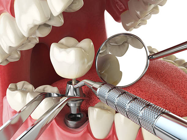 Best Emergency Tooth Extraction in Westwood Shores, TX